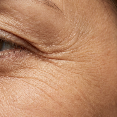 Fine lines & wrinkles