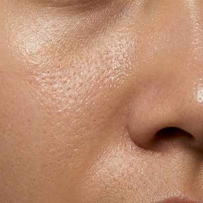 Large, sagging pores